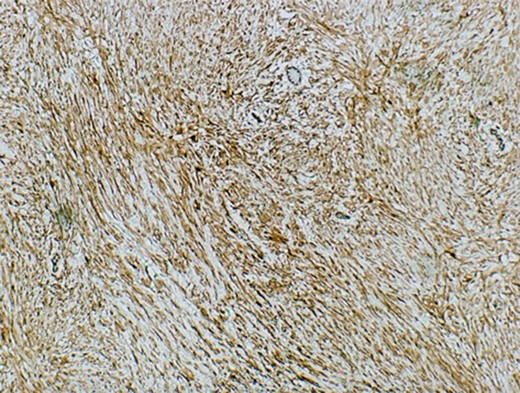 Microscopic images of beta catenin positive mesenteric fibromatosis tumor cells.