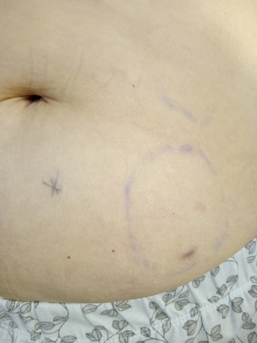 Photograph of patient’s left lower abdomen showing point of maximal tenderness (X) and indelible pen circle marked before failed surgical endoscopy. Photo: Donna D.