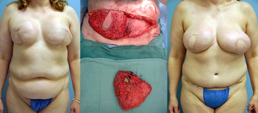 Pre, intra and 2-year postoperative images of patient #1 (left to right).