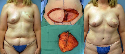 Pre, intra and 1-year postoperative images of patient #2 (left to right).