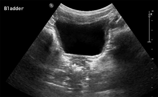 View of bladder on ultrasound.