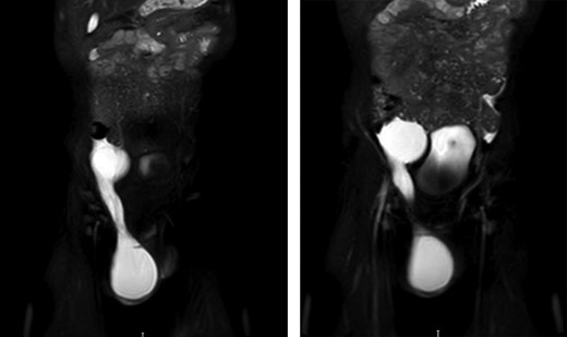 Abdominal MRI displaying abdomino-scrotal connection.