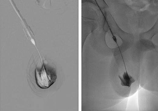 Image intensifier guided sclerotherapy.