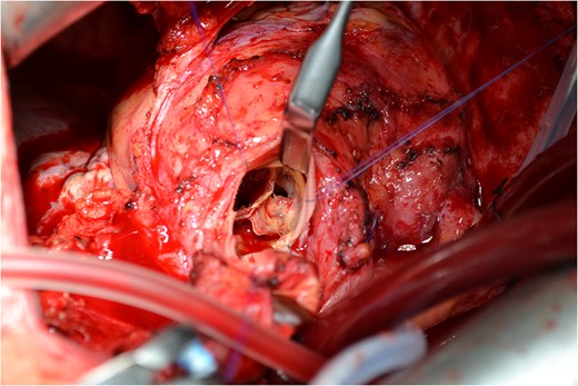 Sever degeneration of the valve leaflets with the formation of perforation in the three prosthetic valve leaflets.