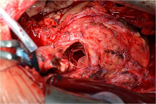 The new implanted aortic valve prosthesis on the aortic conduit.