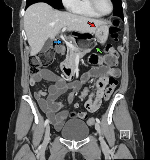The cecum is absent from the right lower quadrant and is located between the liver and stomach (red arrow) visualized as an air-fluid level (green arrow). Compression of the portal vein by herniated contents is demonstrated (blue arrow).