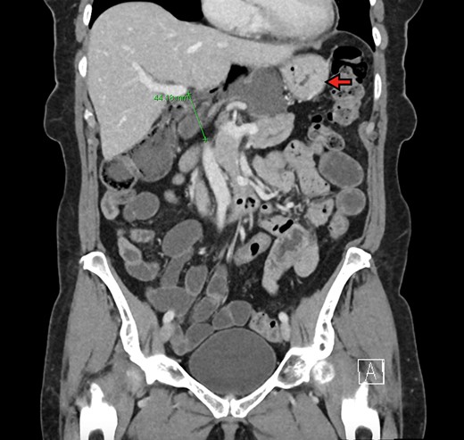 Coronal view demonstrating FoW measurement and herniated contents. The stomach is demonstrated by the red arrow. The FoW is shown to be dilated at 4.4 cm.