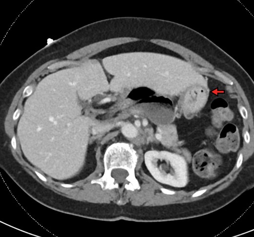 Axial view demonstrating multiple air-fluid levels posterior to the liver and adjacent to the stomach (red arrow).