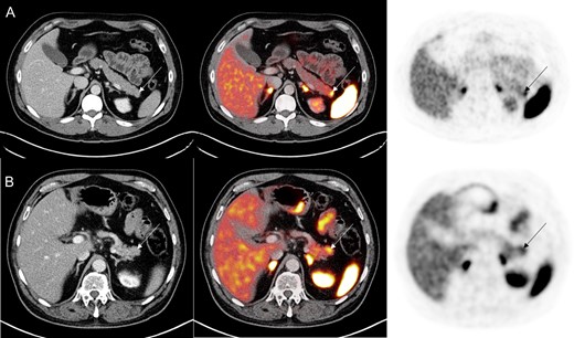 (A) 68Ga PET/CT DOTATATE demonstrating increased DOTATATE uptake (SUVmax 9.7) in the distal pancreas without underlying pancreatic mass in the first case study. (B) In the second case study, 68Ga PET/CT DOTATATE revealed increased DOTATATE uptake (SUVmax 7.6) in the pancreatic tail without any CT abnormality.