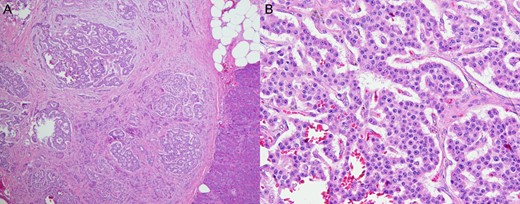 Pathology from the first operation on the first case study patient. (A) H&E stain at low magnification (×40) shows a well-defined border between the tumor and normal pancreatic tissue (right lower). (B) High magnification (×200) shows the tumor cells forming anastomosing cords, with ‘salt-and-pepper’ chromatin and eosinophilic, granular cytoplasm.
