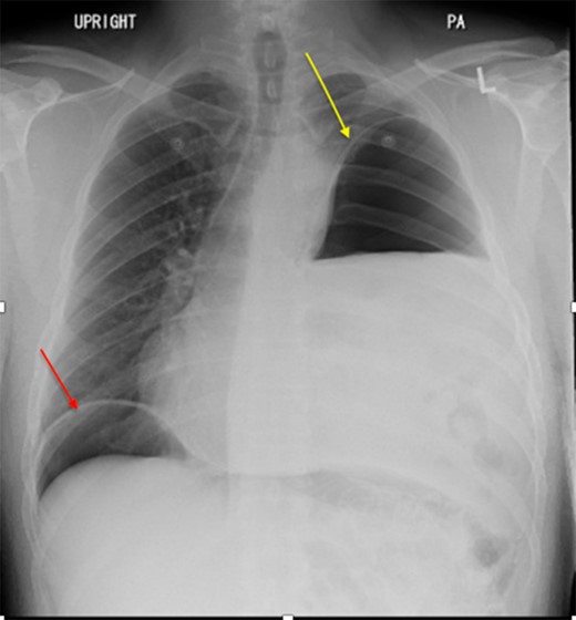 Chest x-ray showed a moderate left hemidiaphragm elevation with bowel contents overlying the left chest.