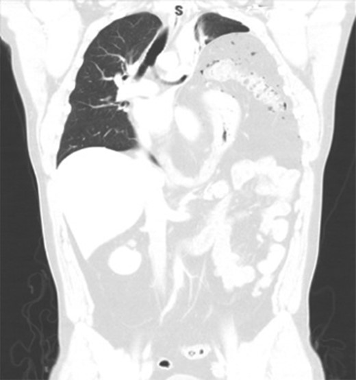 CT scan showing collapse of left lung and left diaphragmatic hernia.