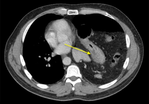 CT scan confirming rightward mediastinal shift.