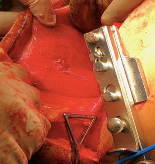 Intra operative photo depicting gastric perforation on greater curvature.