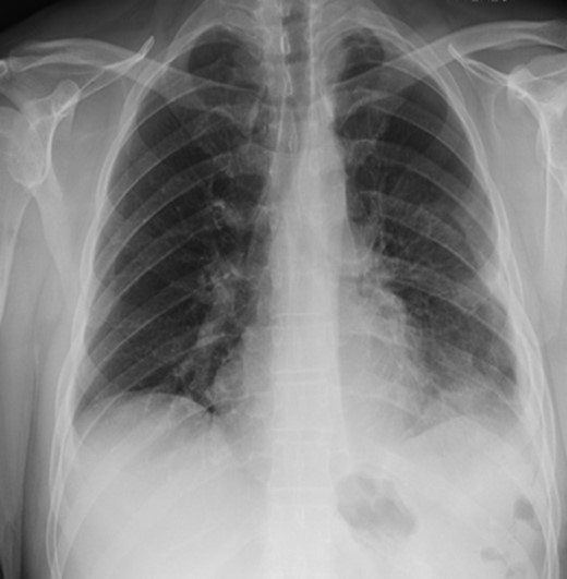 Chest x-ray on follow-up visit post-operative showing stability of repair.