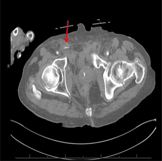 Computed tomography (CT) (axial view) of the abdomen and pelvis demonstrating blush of contrast from distal branch of the right internal iliac artery.