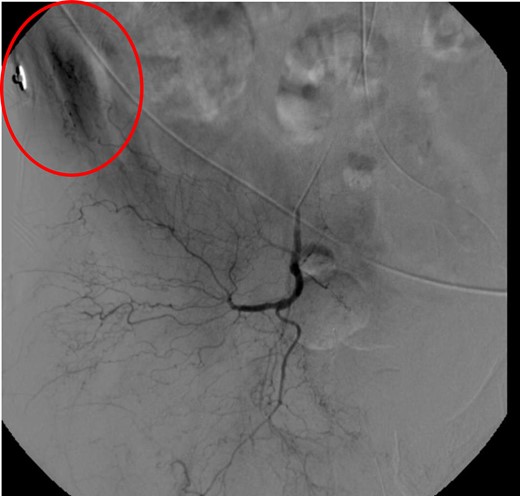 CT angiogram delayed phase of angiogram shows early venous filling consistent with AV fistula.