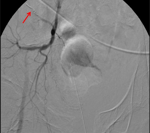 CT angiogram demonstrating microcoil embolization of AV fistula.