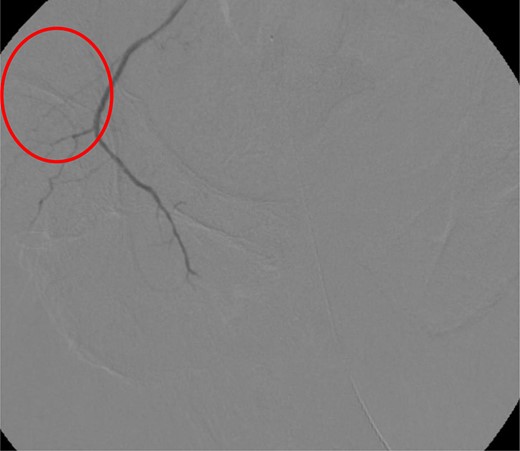 CT angiogram demonstrating successful embolization of AV fistula.