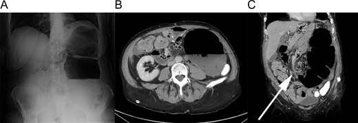 Radiographic findings. (A) Upright plain film showing massive colonic distention. (B) Axial slice of CT scan showing a 14 cm diameter colon. Note the oral contrast filling the descending colon. (C) Coronal slice of CT scan. The arrow indicates mesenteric swirling in the mid-abdomen.