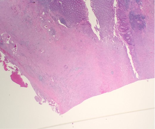 Microscopic examination reveals thickened appendicial wall with infiltrating individual malignant cells.