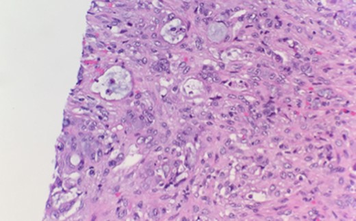 High-power examination reveals some malignant cells demonstrating Signet ring cell features.