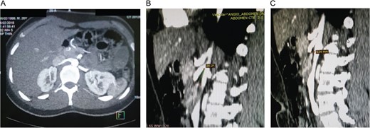 (A) Narrowing at the level of the origin of the superior mesenteric artery without signs of obstruction. (B) Vascular reconstruction showing a 20.5° aortomesenteric angle. (C) Vascular reconstruction showing a closed aortomesenteric angle and a short aortomesenteric distance.