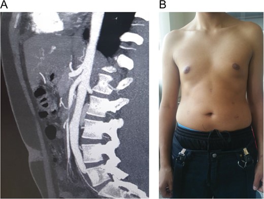 (A) Vascular reconstruction of the patient. (B) Patient 4 months after complete recovery, laparoscopic scars showing on his abdomen.