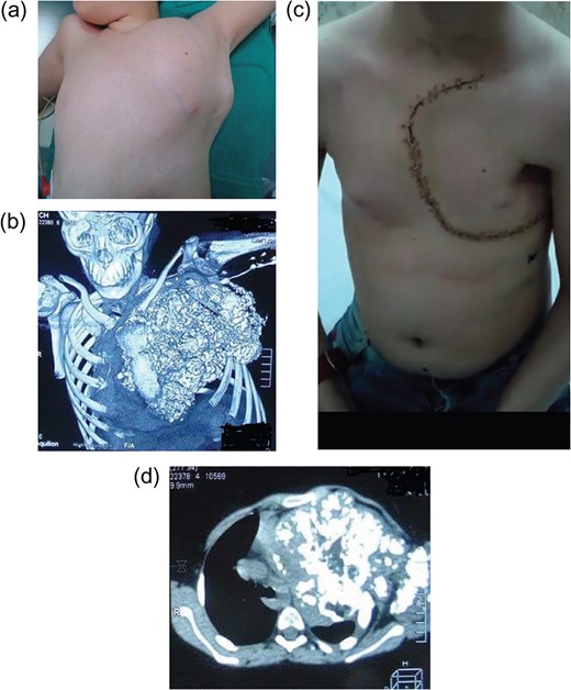 (a) A 12- year-old boy presented with a large chest wall mass, later diagnosed with osteochondroma. (b) 3D CT scans of the chest showing the large lobulated calcified mass. (c) Patient’s picture at follow up with no diformity and left anterolateral thoracotomy incision. (d) CT scans of the chest showing a large calcified mass extending from the upper chest to the left diaphragm.