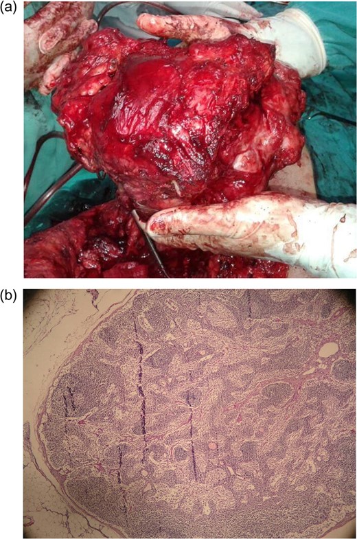 (a) A completely resected large osteochondroma measuring 17 Ă— 17 cm2 with ribs and the left upper lobe. (b) Low power view of cartilaginous cap with chondrocytes are arranged in an orderly fashion.