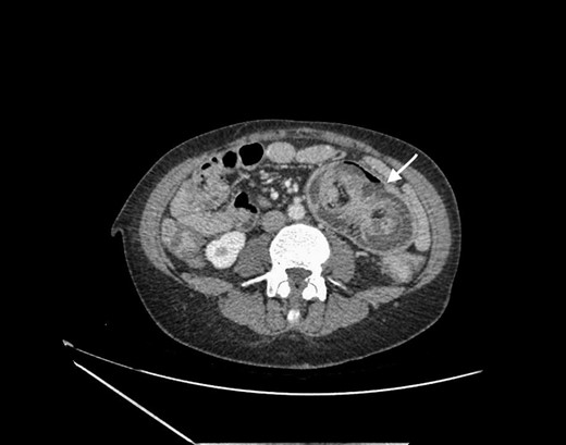 Abdominal CT scan showing small bowel intussusception with the target sign (white arrow).
