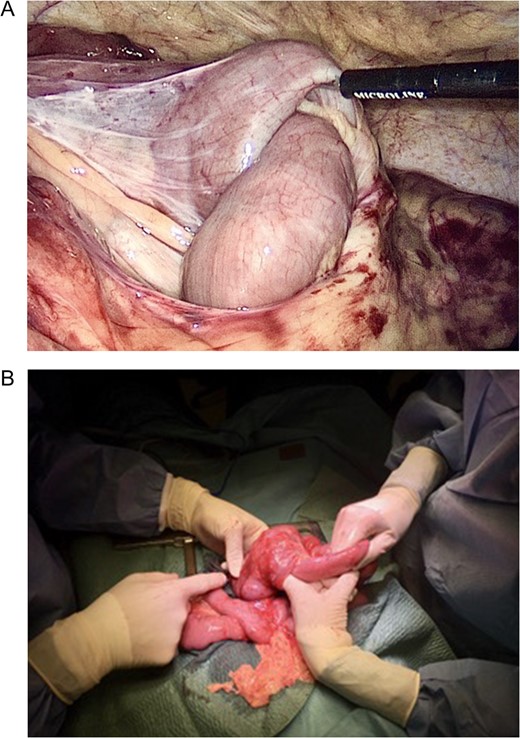 (A and B) Laparoscopic and open images of the intussuscepted bowel.