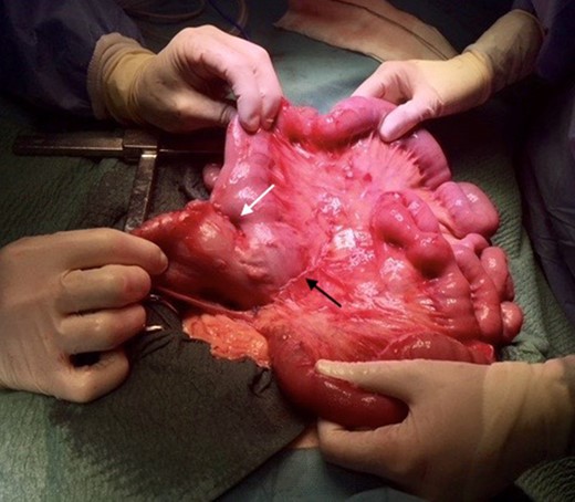 Surgical treatment. Pexy of the Roux limb to the biliopancreatic limb (white arrow) and closure of the mesenteric defect (black arrow).