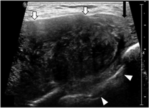 Transverse targeted ultrasound image of palpable breast mass show a large heterogeneously, hypoechoic mass with internal vascularity, well defined (white arrows). Mass extends between the ribs into the intercostal space (arrowheads). Beak like appearance at the lateral margin (characteristic ‘fascial tail’ sign, black arrow).