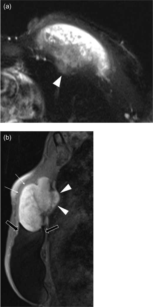 Axial T2 weighted half-fournier acquired single-shot turbo spin echo (HASTE) (a), and sagittal fat suppression (b) images of left breast mass. The pectoralis major muscle (white arrows) overlies the large mass that extends into the intercostal space (arrowheads) between the second and third ribs. The lobulated mass is in direct contact with the breast implant (black arrows).