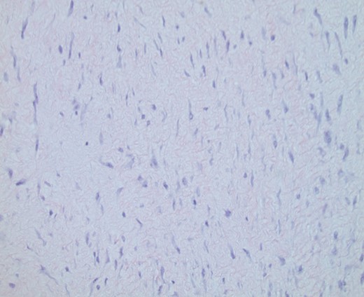Original CNB demonstrating spindle cell lesion. Hematoxylin and eosin (H&E) ×100 magnification.