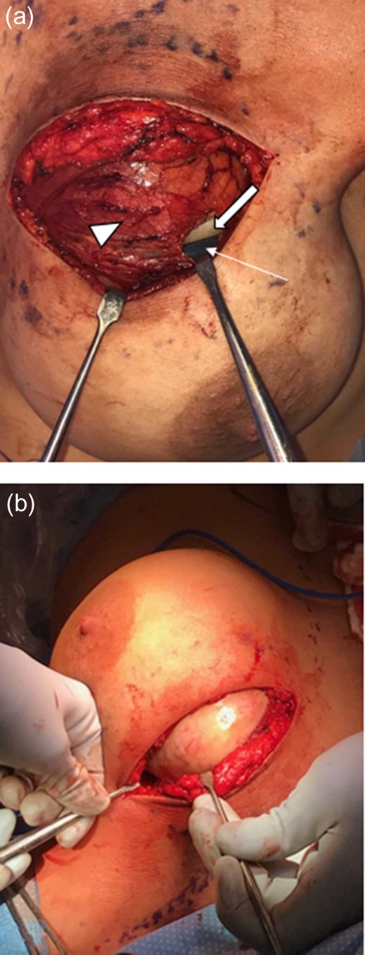 Intraoperative images. (a) Capsule (arrow head) surrounds the mass (block arrow) and adjacent implant (arrow). (b) Capsule is retracted revealing white mass.