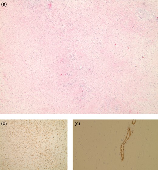Resected mass at ×40 magnification (a) shows long fascicles of spindle cells. Nuclear positivity with β-catenin (b), and immuno-stain for CD34 highlights the blood vessels (c), the neoplastic cells are CD34 negative.