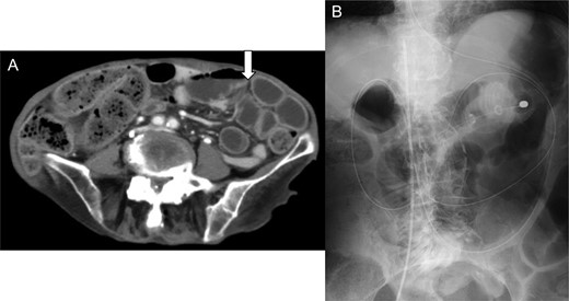 (A) Enhanced abdominal computed tomography on admission showing a dilation of the small intestine (white arrow). The patient was diagnosed with ileus state. (B) X-ray of the abdomen revealed an ileus tube and the central venous catheter inserted from the right femoral vein.