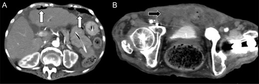 Enhanced abdominal computed tomography 1 day after admission showing (A) free air in the abdominal cavity (white arrow) and (B) massive fluid collection in the posterior space of the urinary bladder (black arrow).