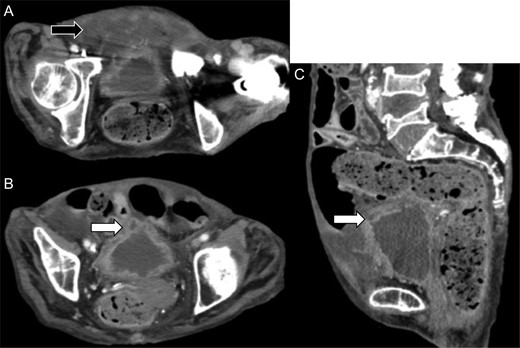 Review of the enhanced abdominal computed tomography on admission after the operation revealed (A) fluid collection in the posterior space of the urinary bladder (black arrow) and (B and C) deficit in the urinary bladder wall and suspected perforation (white arrow).