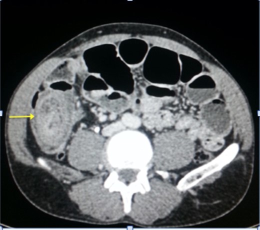 Axial section of abdominal CT showing the‘target mass’.