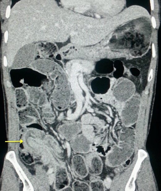 Coronal reconstruction of abdominal CT showing the ‘sausage sign’ of ileocecal intussusception.