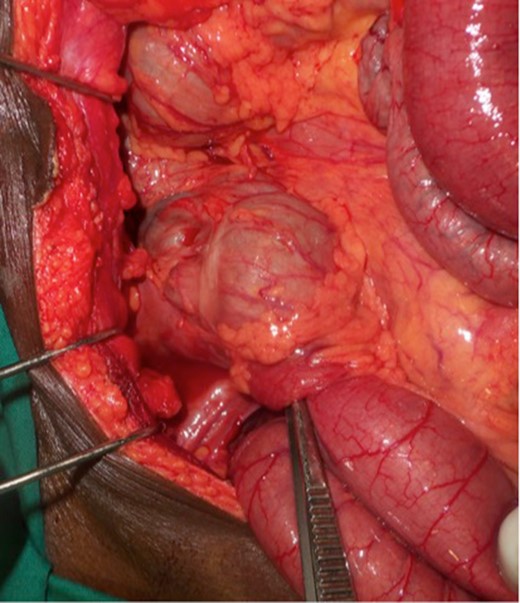Intraoperative view of the ileocecal intussusception.