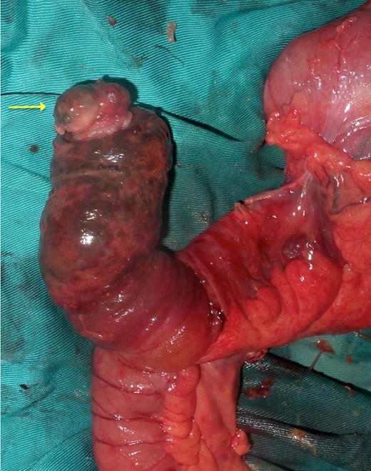 View of the surgical specimen with the ileal polyp.