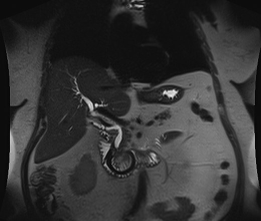 Magnetic resonance cholangiopacreaticogram (MRCP) preporatively.