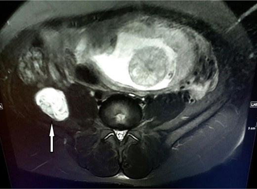 MR imaging of the cystic lesion.