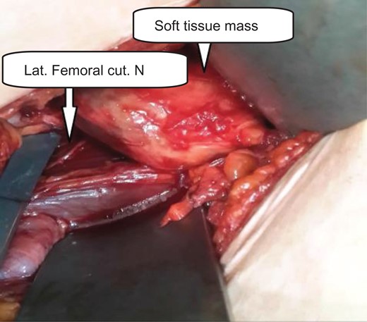 Cystic mass densely adhered to lateral femoral cutaneous nerve; before dissection.
