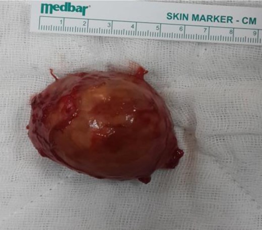 Cystic mass removed.