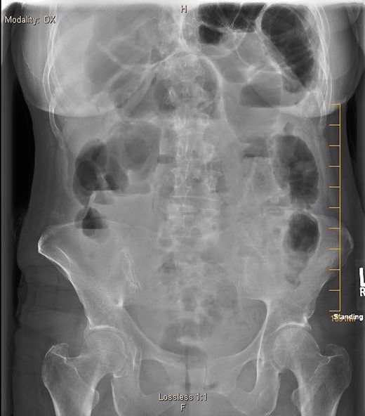 7.4.18: XR abdomen acute complete w/chest: dilated small bowel loops in LUQ, air fluid levels in right mid abdomen, paucity of large bowel gas, suggestive of small bowel obstruction, suggestion of free air.